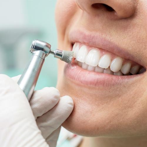 Professional smile cleaning